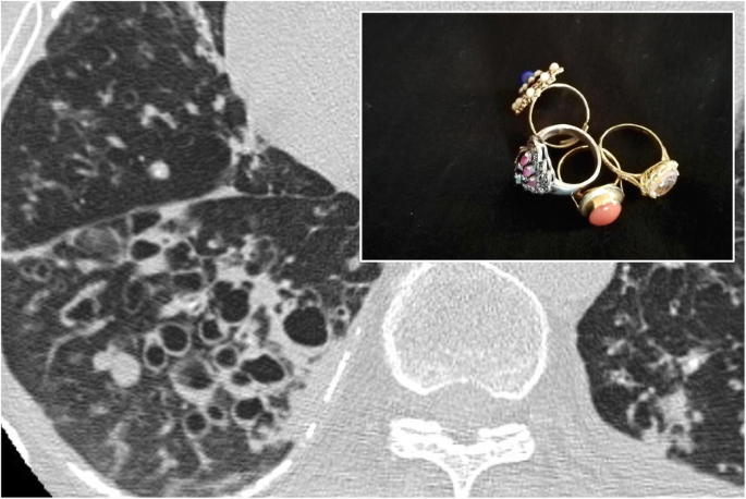 Chest imaging using signs, symbols, and naturalistic images: a practical  guide for radiologists and non-radiologists | Insights into Imaging | Full  Text