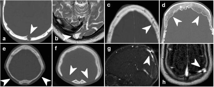 Imaging of skull vault tumors in adults | Insights into Imaging | Full Text