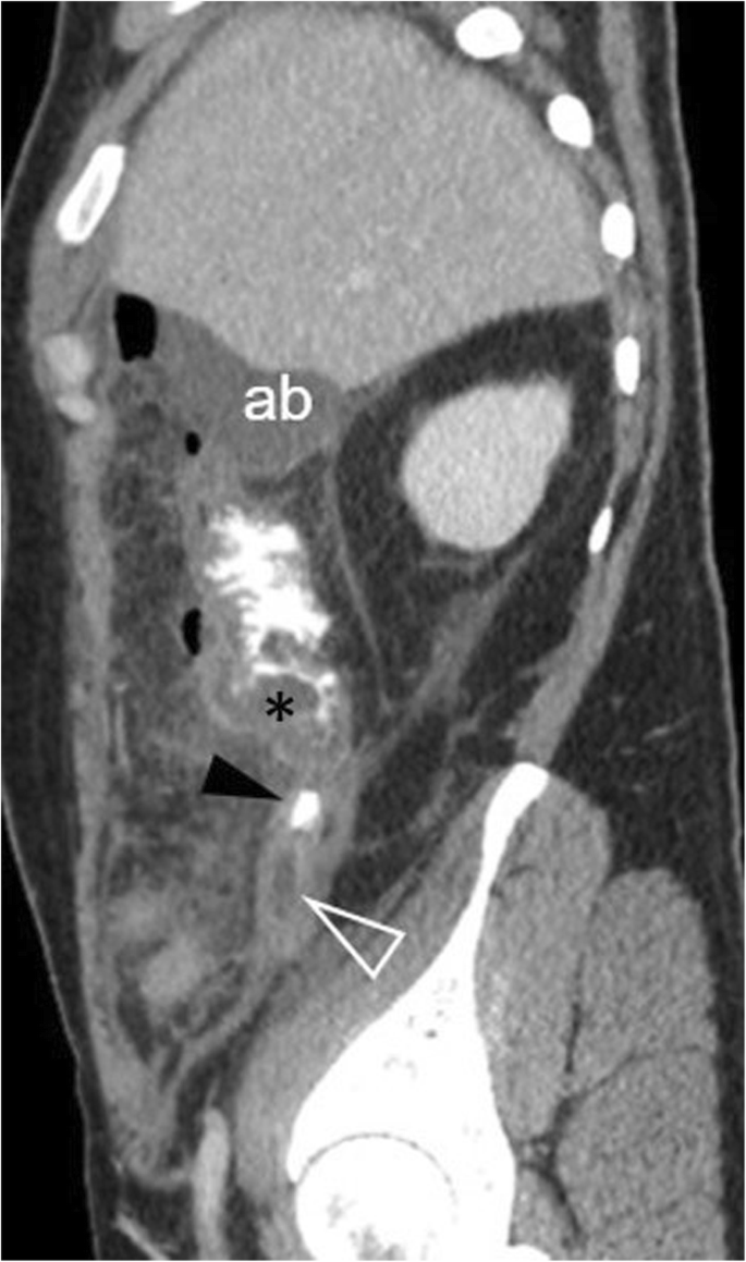 Gastrointestinal perforation: clinical and MDCT clues for identification of  aetiology | Insights into Imaging | Full Text