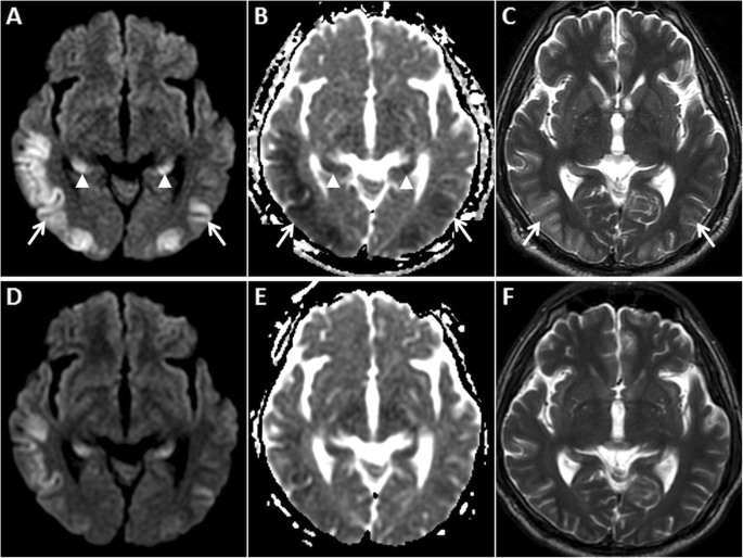 Gyriform restricted diffusion in adults: looking beyond thrombo-occlusions  | Insights into Imaging | Full Text