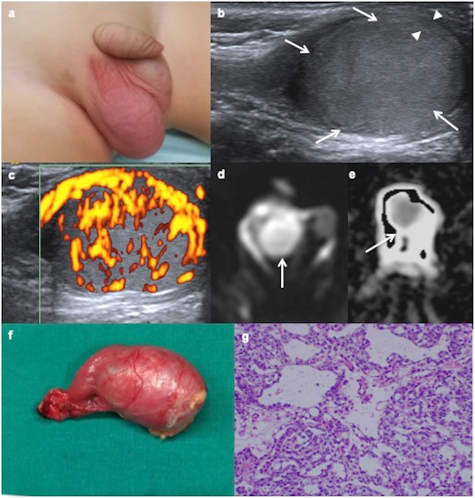 Testicular tumours in children: an approach to diagnosis and management  with pathologic correlation | Insights into Imaging | Full Text