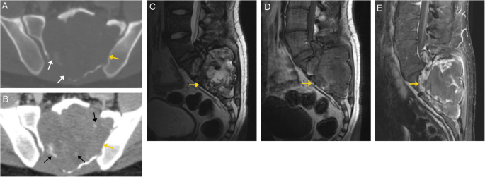 Bone Up On Spinal Osseous Lesions A Case Review Series Insights Into Imaging Full Text