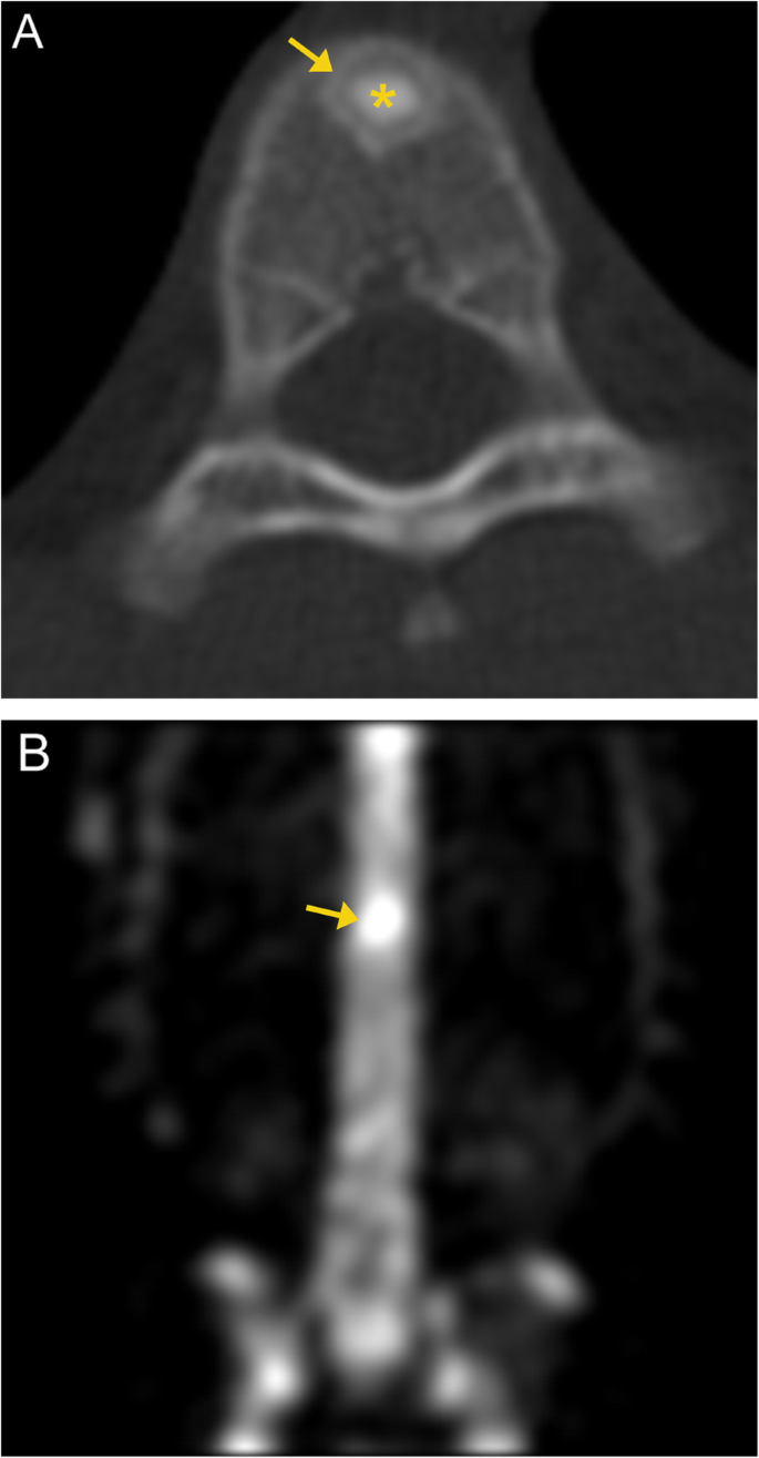 Bone up on spinal osseous lesions: a case review series | Insights into  Imaging | Full Text