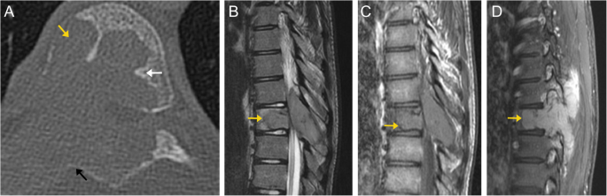 lesions on mri t spine