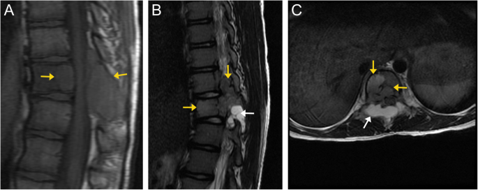 Bone up on spinal osseous lesions: a case review series | Insights into  Imaging | Full Text