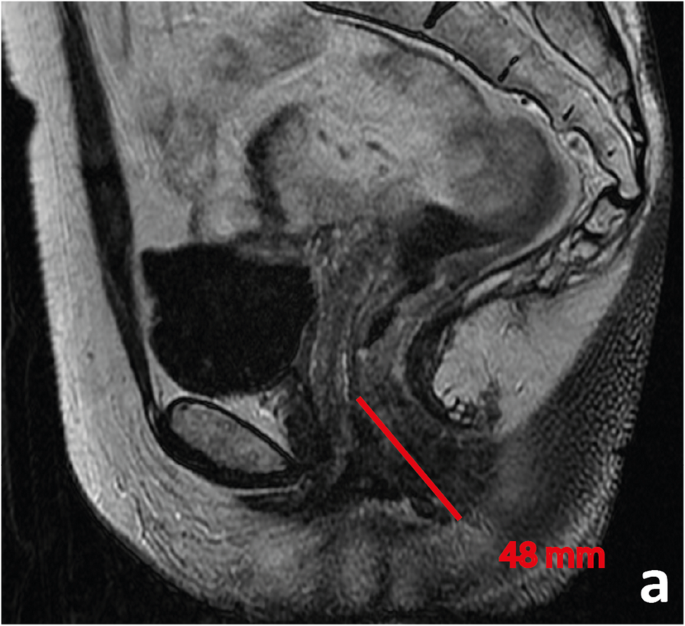 rectosigmoid rák mri)