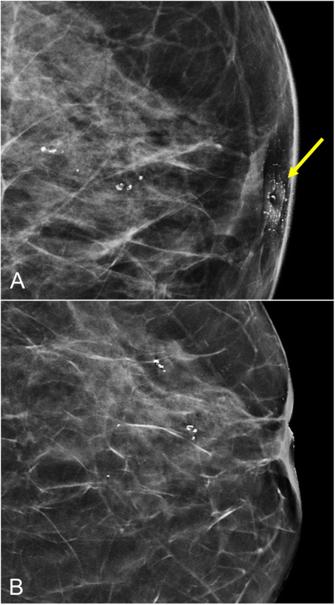 PDF] A Review of Breast Pain: Causes, Imaging Recommendations, and Treatment