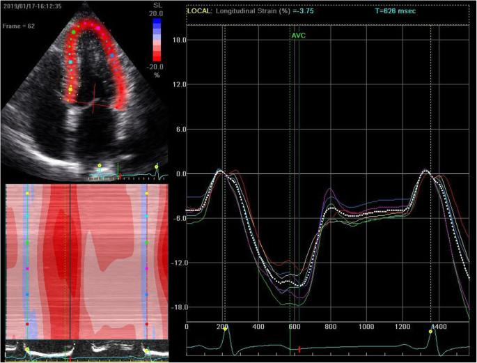 The value of 2D speckle-tracking strain echocardiography in evaluating the  relationship between carotid elasticity and left ventricular systolic  function in patients with diabetic nephropathy, Insights into Imaging