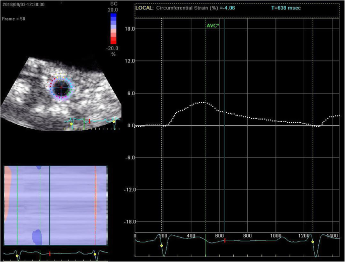 The value of 2D speckle-tracking strain echocardiography in evaluating the  relationship between carotid elasticity and left ventricular systolic  function in patients with diabetic nephropathy, Insights into Imaging