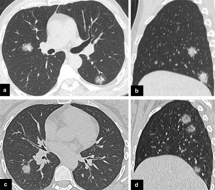 Pneumonia covid organizing in [PDF] Organizing