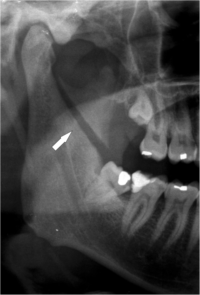 Panoramic and Towne view radiographs of right mandibu- lar angle