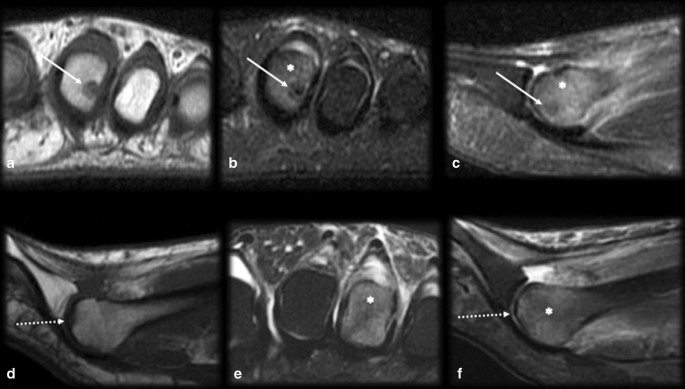 Osteoid Osteoma The Great Mimicker Insights Into Imaging Full Text