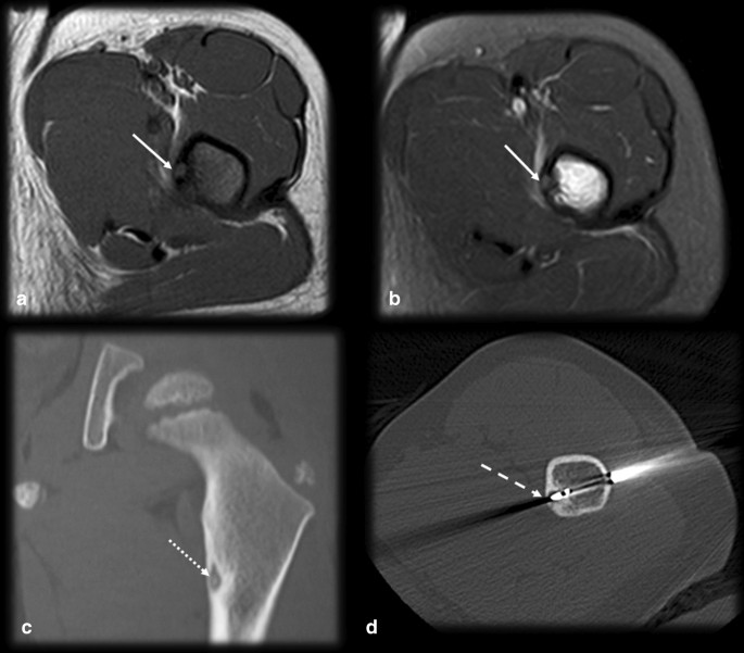 Osteoid Osteoma The Great Mimicker Insights Into Imaging Full Text