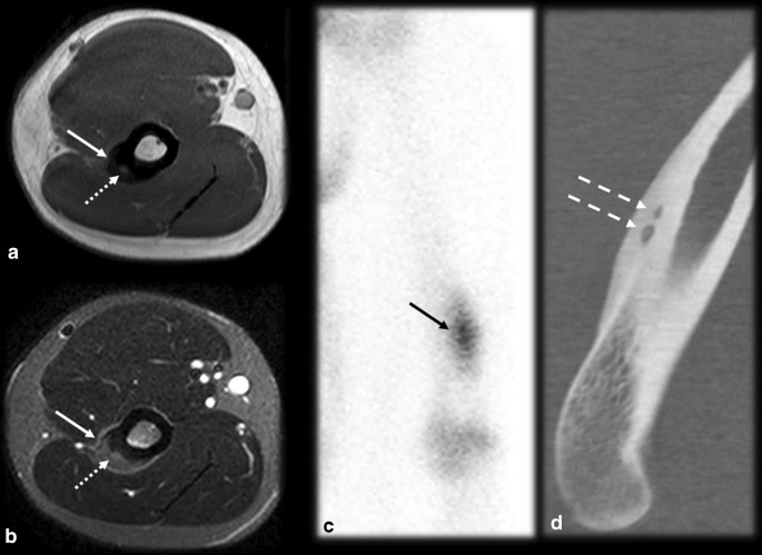 Osteoid osteoma