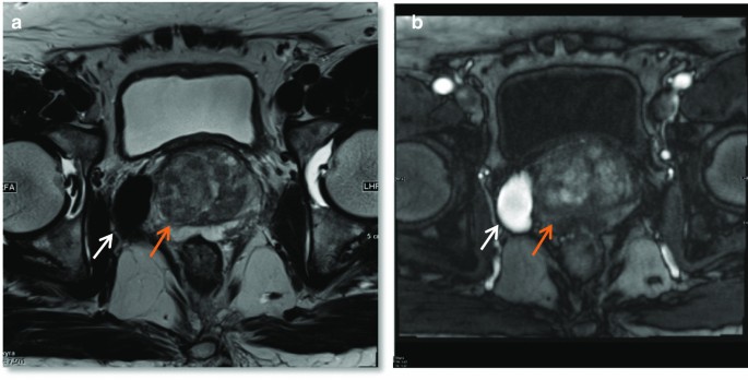 mri prostate cyst