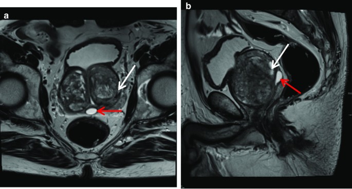 prostate cyst mri