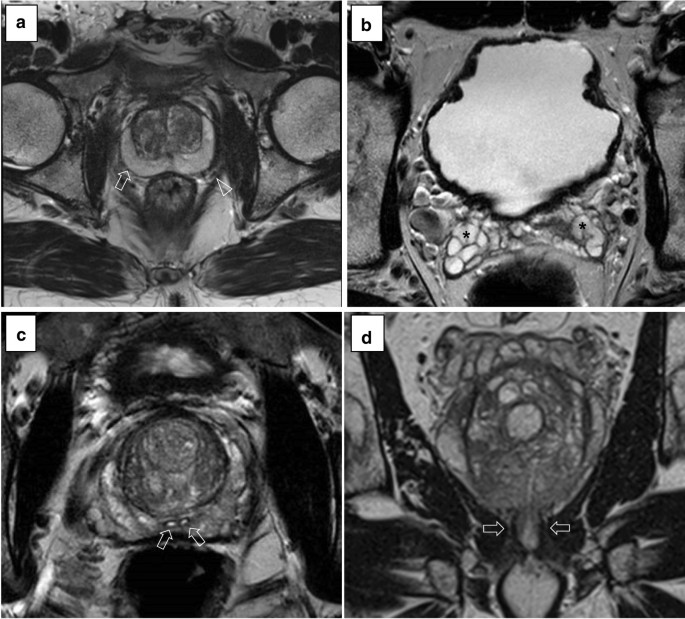 prostate mri fleet enema)