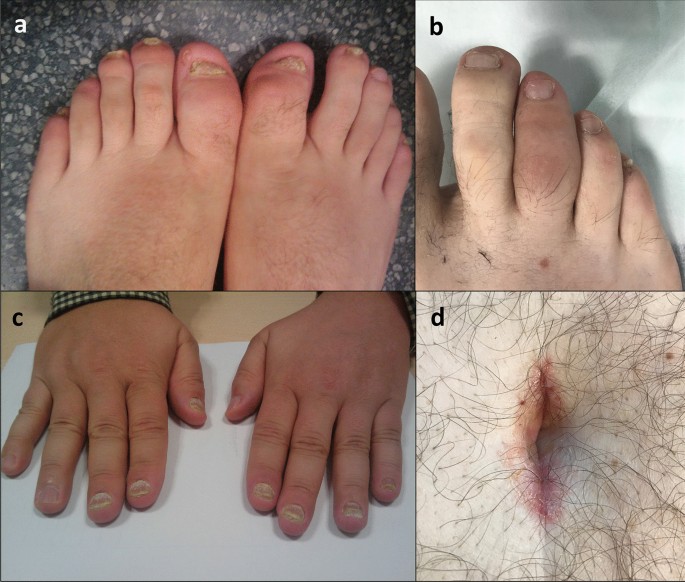 psoriatic arthritis toes