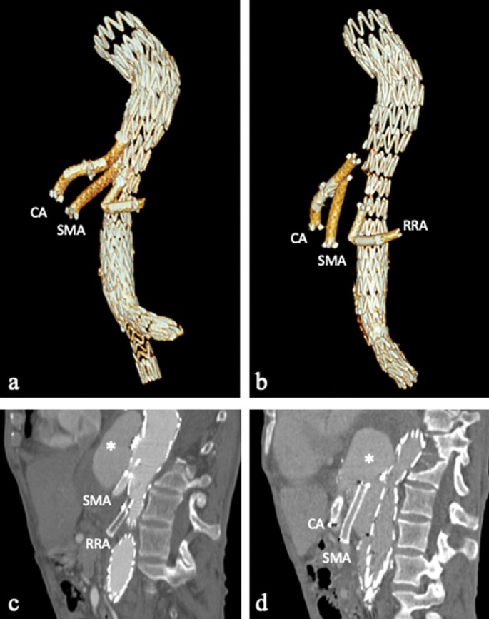 Explanation of terms. The contrast medium aortic arrival time is