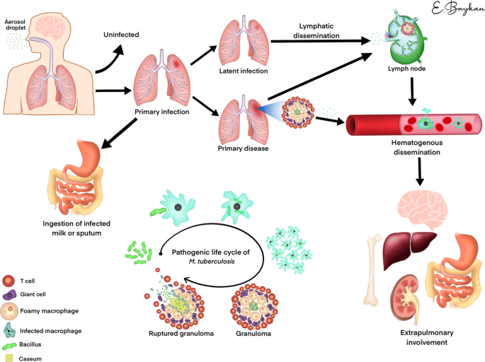 extrapulmonary tuberculosis symptoms