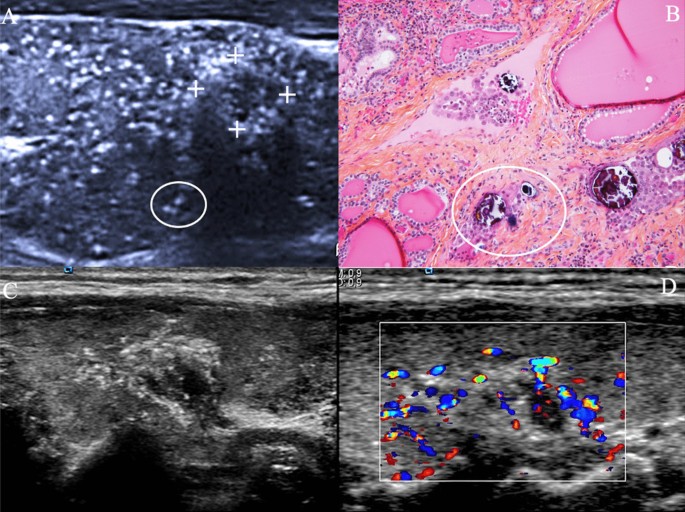 papillary thyroid carcinoma gross