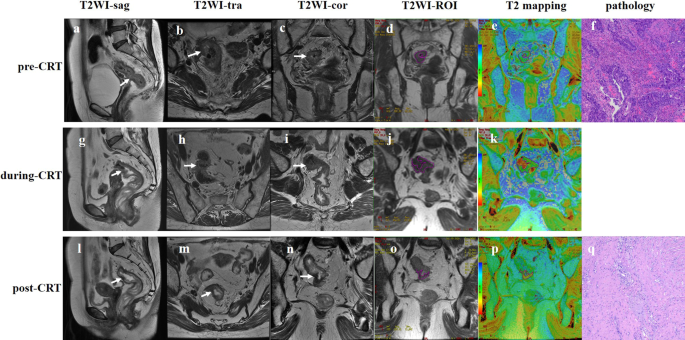 T2 Relaxation Times at Cardiac MRI in Healthy Adults: A Systematic