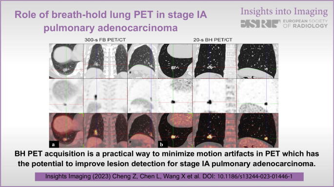 Role of breath-hold lung PET in stage IA pulmonary adenocarcinoma |  Insights into Imaging | Full Text