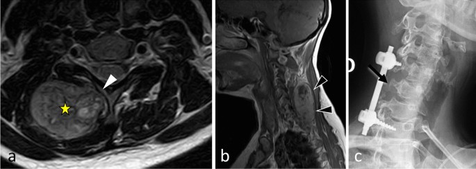 Understanding a mass in the paraspinal region: an anatomical