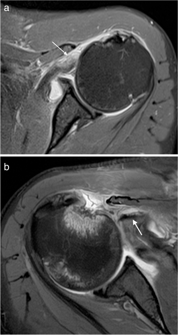 Rotator cuff tear patterns: MRI appearance and its surgical relevance |  Insights into Imaging | Full Text