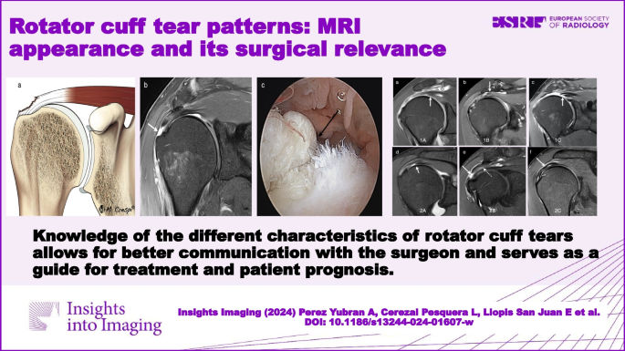 Different Types of Rotator Cuff Surgery