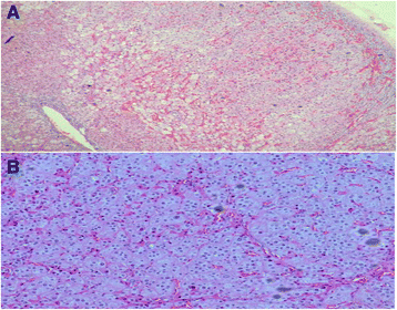Prkar1a Negative Familial Cushing S Syndrome Two Case Reports Journal Of Medical Case Reports Full Text