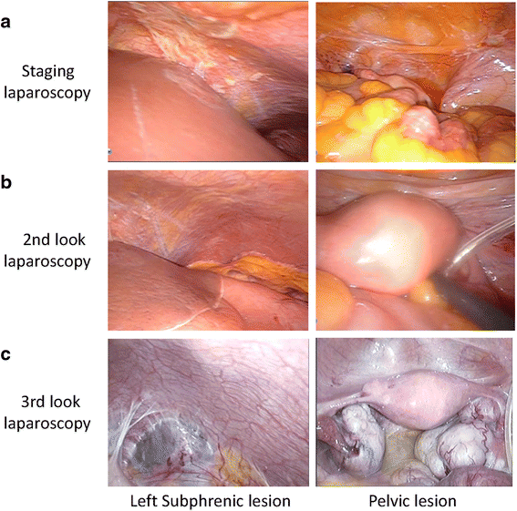 A Patient With Gastric Cancer With Peritoneal Carcinomatosis Treated With  Intraperitoneal Chemotherapy Who Survived More Than 5 Years Receiving  Repeated Laparoscopic Examinations: A Case Report | Journal Of Medical Case  Reports | Full Text