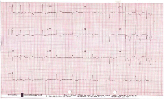 Left ventricular hypertrophy - Symptoms and causes - Mayo Clinic