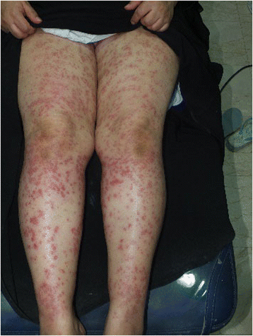 Purpura induced by laser hair removal: a case report | Journal of Medical  Case Reports | Full Text