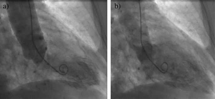 FULL TEXT - Mid-ventricular takotsubo: A case report - International  Journal of Case Reports and Images (IJCRI)