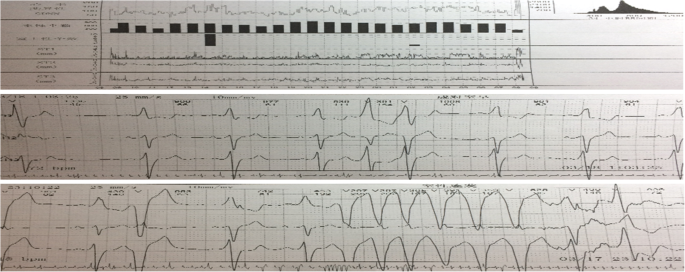 Dilated Cardiomyopathy in Acromegaly: a Case Report with Cardiac MR Findings