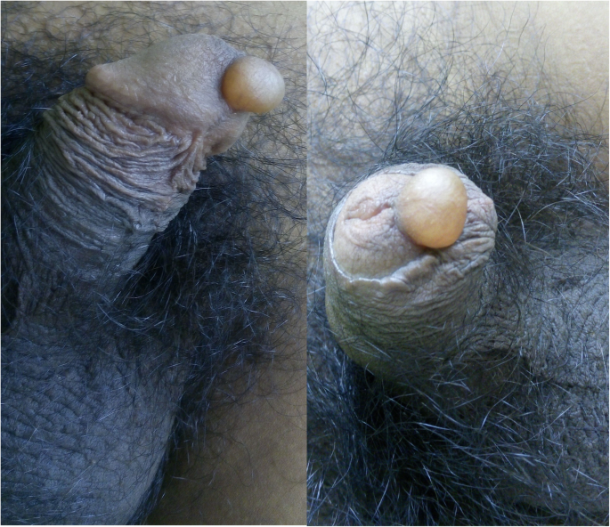 Mărirea penisului - Titan Gel Borșa