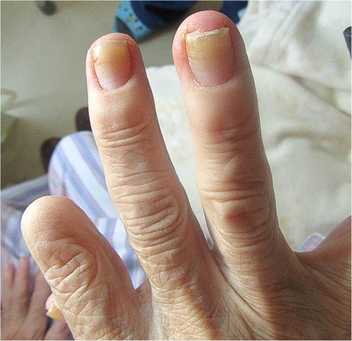 Yellow nail syndrome following multiple orthopedic surgeries: a case report  | Journal of Medical Case Reports | Full Text