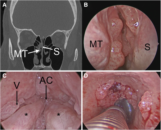 inverted papilloma nasopharynx)