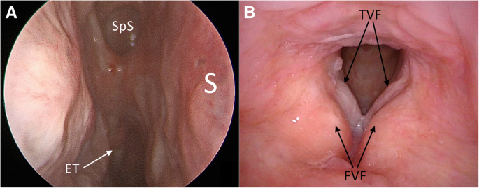 Squamous papilloma of the nasal septum - Nasal squamous papilloma