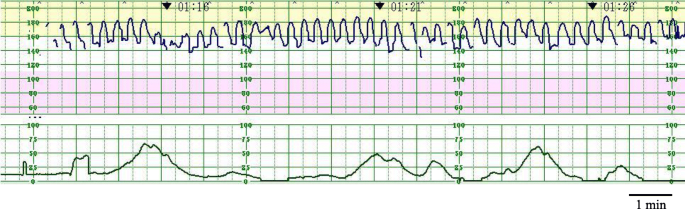 reactive fetal heart rate tracing