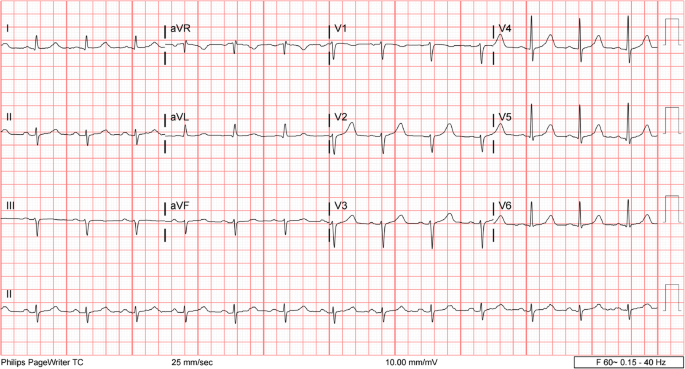 Acute Inferior St Elevation Myocardial Infarction Due To Delirium Tremens A Case Report Journal Of Medical Case Reports Full Text