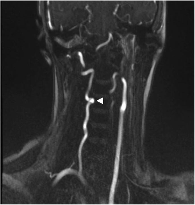 vertebral artery