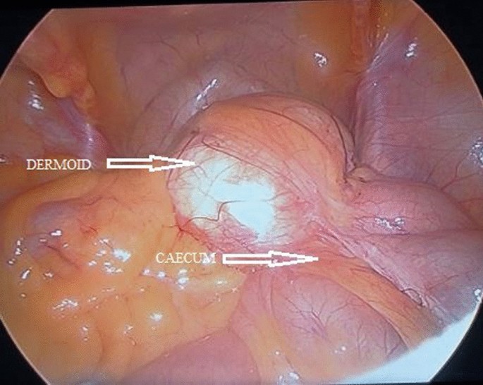 Dermoid cyst ovary