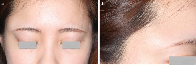 A Dermoid Cyst Misdiagnosed As A Lipoma Due To Atypical Magnetic Resonance Images A Case Report Journal Of Medical Case Reports Full Text