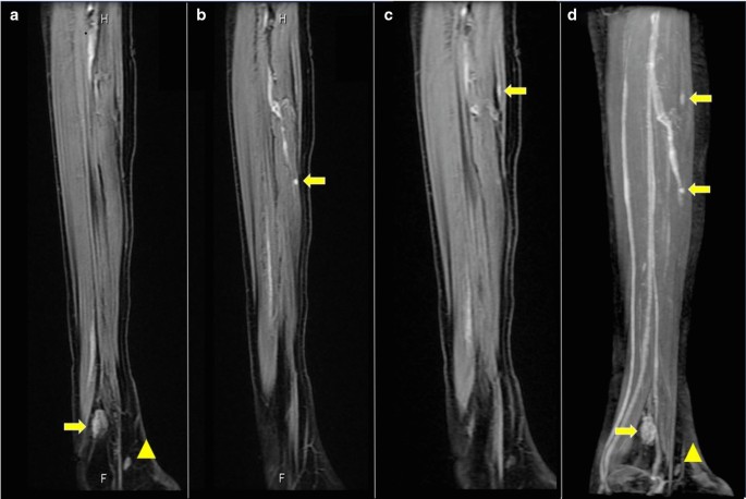 leg muscle atrophy