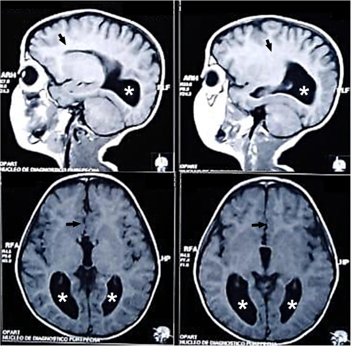 Isolated Agenesis Of The Corpus Callosum And Normal General Intelligence Development During Postnatal Life A Case Report And Review Of The Literature Journal Of Medical Case Reports Full Text