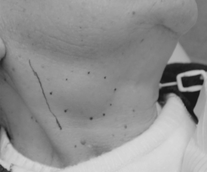 Submandibular Lymph Nodes Submandibular Lymph Nodes