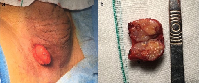 Scrotal wall leiomyosarcoma: a case report and review of the literature |  Journal of Medical Case Reports | Full Text
