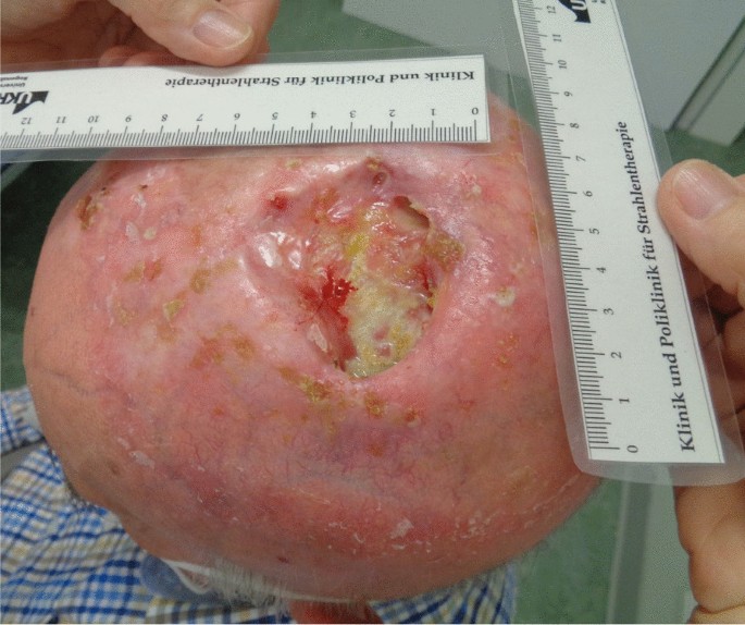 late squamous cell carcinoma